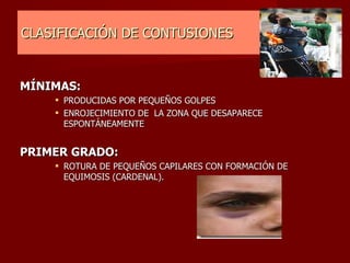 CLASIFICACIÓN DE CONTUSIONES MÍNIMAS: PRODUCIDAS POR PEQUEÑOS GOLPES ENROJECIMIENTO DE  LA ZONA QUE DESAPARECE ESPONTÁNEAMENTE   PRIMER GRADO: ROTURA DE PEQUEÑOS CAPILARES CON FORMACIÓN DE EQUIMOSIS (CARDENAL).   