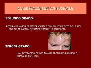 CLASIFICACIÓN DE CONTUSIONES SEGUNDO GRADO:   ROTURA DE VASOS DE MAYOR CALIBRE CON ABULTAMIENTO DE LA PIEL POR ACUMULACIÓN DE SANGRE BAJO ELLA (CHICHÓN) TERCER GRADO: HAY ALTERACIÓN DE LOS PLANOS PROFUNDOS (MÚSCULO, GRASA, HUESO, ETC). 