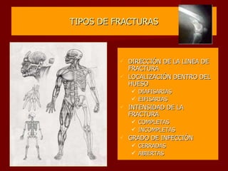 TIPOS DE FRACTURAS DIRECCIÓN DE LA LINEA DE FRACTURA LOCALIZACIÓN DENTRO DEL HUESO DIAFISARIAS EIFISARIAS INTENSIDAD DE LA FRACTURA COMPLETAS INCOMPLETAS GRADO DE INFECCIÓN CERRADAS  ABIERTAS 
