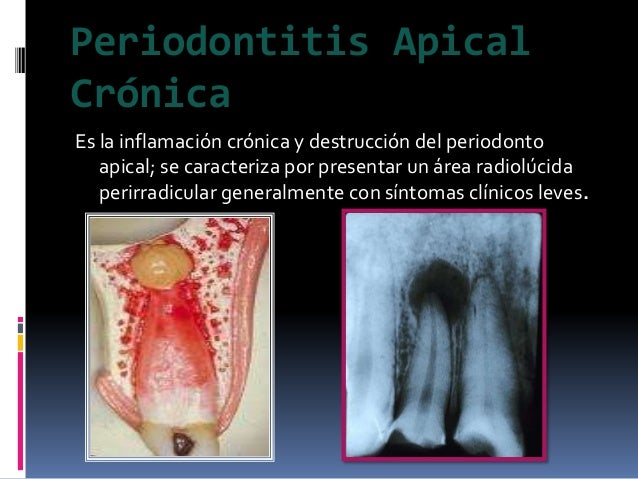 Periodontitis apical cronica pdf