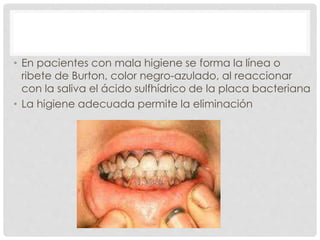 • En pacientes con mala higiene se forma la línea o
ribete de Burton, color negro-azulado, al reaccionar
con la saliva el ácido sulfhídrico de la placa bacteriana
• La higiene adecuada permite la eliminación
 