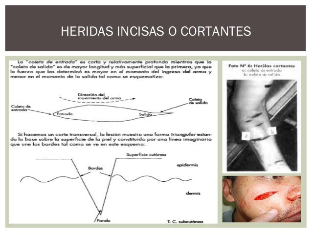 Lesiones por arma blanca
