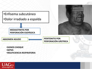 •Enfisema subcutáneo
•Dolor irradiado a espalda
MEDIASTINITIS POR
PERFORACIÓN ESOFÁGICA
ABDOMEN AGUDO PERITONITIS POR
PERFORACIÓN GÁSTRICA
•SIGNOS CHOQUE
•SEPSIS
•INSUFICIENCIA RESPIRATORIA
 