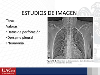 ESTUDIOS DE IMAGEN
Tórax
Valorar:
•Datos de perforación
•Derrame pleural
•Neumonía
 