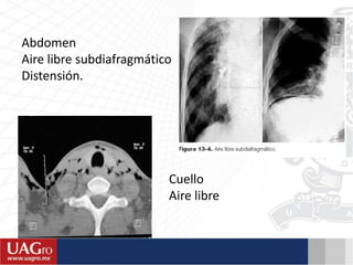 Abdomen
Aire libre subdiafragmático
Distensión.
Cuello
Aire libre
 