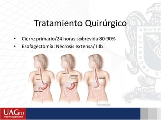 Tratamiento Quirúrgico
• Cierre primario/24 horas sobrevida 80-90%
• Esofagectomía: Necrosis extensa/ IIIb
 