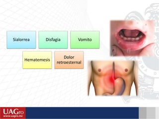 Sialorrea Disfagia Vomito
Hematemesis
Dolor
retroesternal
 