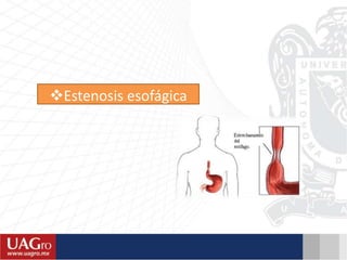 Estenosis esofágica
 