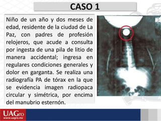 CASO 1
Niño de un año y dos meses de
edad, residente de la ciudad de La
Paz, con padres de profesión
relojeros, que acude a consulta
por ingesta de una pila de litio de
manera accidental; ingresa en
regulares condiciones generales y
dolor en garganta. Se realiza una
radiografía PA de tórax en la que
se evidencia imagen radiopaca
circular y simétrica, por encima
del manubrio esternón.
 
