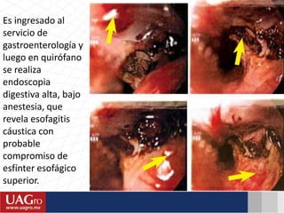 Es ingresado al
servicio de
gastroenterología y
luego en quirófano
se realiza
endoscopia
digestiva alta, bajo
anestesia, que
revela esofagitis
cáustica con
probable
compromiso de
esfínter esofágico
superior.
 