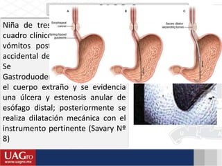 CASO 2
Niña de tres años que inicia su
cuadro clínico dos años antes, con
vómitos posteriores a la ingesta
accidental de una piedra pequeña
Se solicita una
Gastroduodenoscopía y se extrae
el cuerpo extraño y se evidencia
una úlcera y estenosis anular de
esófago distal; posteriormente se
realiza dilatación mecánica con el
instrumento pertinente (Savary Nº
8)
 