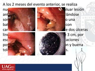 A los 2 meses del evento anterior, se realiza
nueva endoscopia esofágica para evaluar lesión
anterior y continuar dilataciones, hallándose
sorpresivamente, a 20 cm del esófago una
batería plana que también se extrae con
canastilla de Dormia, comprobándose dos úlceras
lineales anchas de aproximadamente 3 cm, por
esofagitis cáustica. Que requirió dilataciones
posteriores. Presenta buena evolución y buena
tolerancia oral todo tipo de alimentos.
 