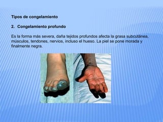 Tipos de congelamiento
2. Congelamiento profundo
Es la forma más severa, daña tejidos profundos afecta la grasa subcutánea,
músculos, tendones, nervios, incluso el hueso. La piel se pone morada y
finalmente negra.
 