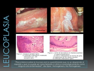 “Placa blanca sobre la mucosa oral no queratinizada que no se desprende al
raspado y que no puede ser caracterizada ni clínica ni patológicamente como
     ninguna otra enfermedad”, dos tipos: Homogénea y No Homogénea.
 