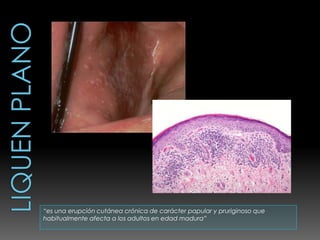 “es una erupción cutánea crónica de carácter papular y pruriginoso que
habitualmente afecta a los adultos en edad madura”
 