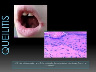 “Estados inflamatorios de la Submucosa labial o comisuras labiales en forma de
                                  boqueras”
 