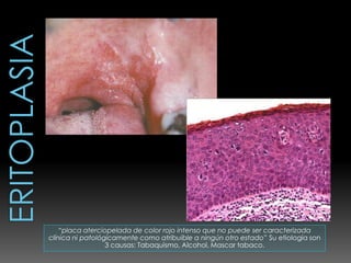 “placa aterciopelada de color rojo intenso que no puede ser caracterizada
clínica ni patológicamente como atribuible a ningún otro estado” Su etiología son
                  3 causas: Tabaquismo, Alcohol, Mascar tabaco.
 