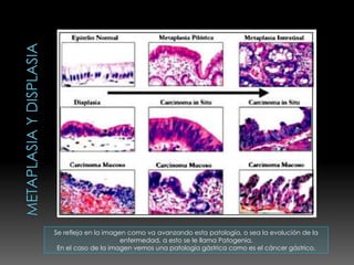 Se refleja en la imagen como va avanzando esta patología, o sea la evolución de la
                      enfermedad, a esto se le llama Patogenia.
 En el caso de la imagen vemos una patología gástrica como es el cáncer gástrico.
 