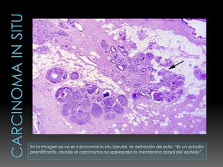 En la imagen se ve el carcinoma in situ lobular, la definición de este: “Es un estadio
preinfiltrante, donde el carcinoma no sobrepasa la membrana basal del epitelio”
 