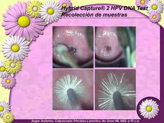 Lesiones PreCancerosas de Cervix