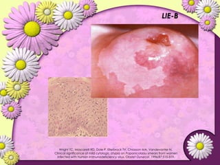 Lesiones PreCancerosas de Cervix