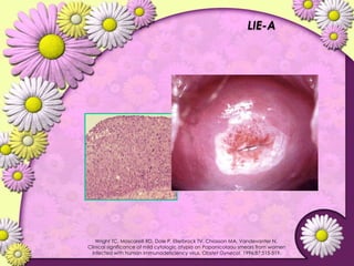 Lesiones PreCancerosas de Cervix