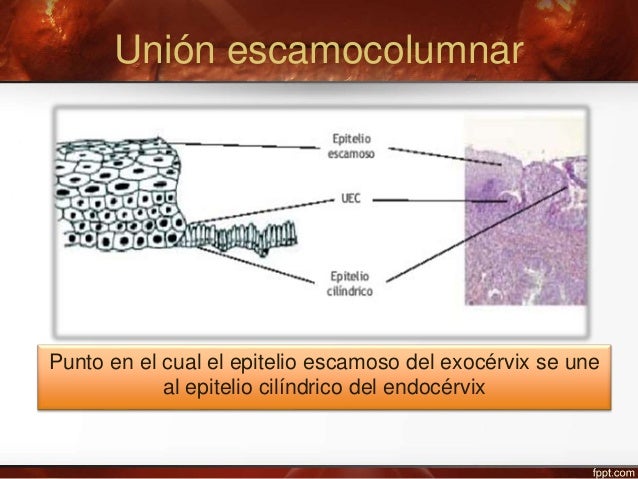Lesiones preinvasoras del cervix