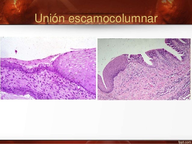Lesiones preinvasoras del cervix