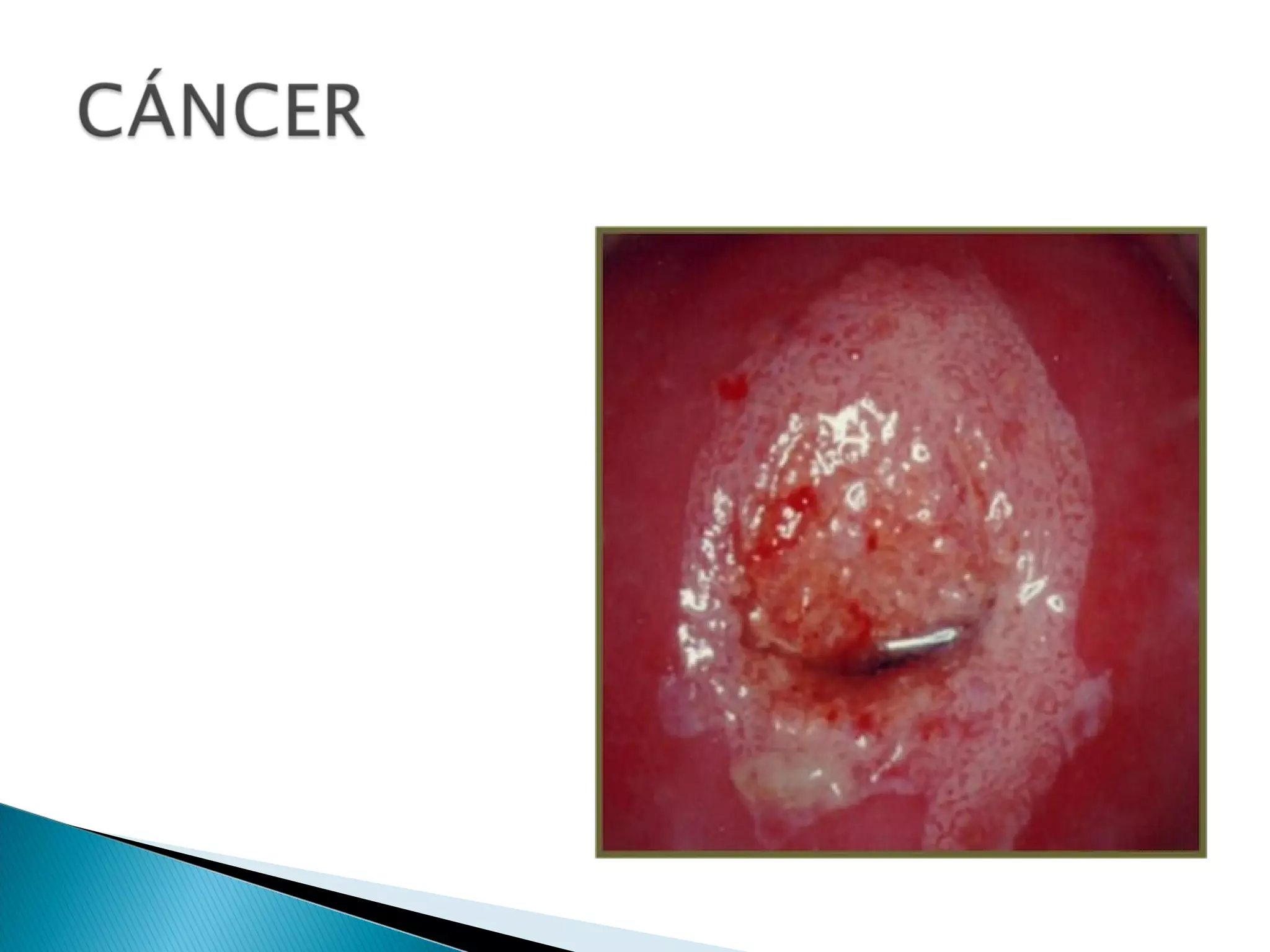 Lesiones premalignas de cacu | PPT