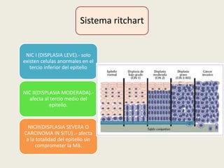Sistema ritchart
NIC I (DISPLASIA LEVE).- solo
existen celulas anormales en el
tercio inferior del epitelio
NIC II(DISPLASIA MODERADA).-
afecta al tercio medio del
epitelio.
NICIII(DISPLASIA SEVERA O
CARCINOMA IN SITU) .- afecta
a la totalidad del epitelio sin
comprometer la MB.
 