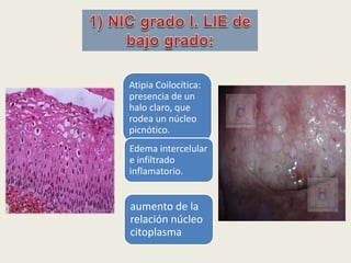 Atipia Coilocítica:
presencia de un
halo claro, que
rodea un núcleo
picnótico.
Edema intercelular
e infiltrado
inflamatorio.
aumento de la
relación núcleo
citoplasma
 