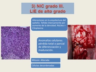 Alteraciones en la arquitectura del
epitelio. Teñido intensamente por
aumento de la densidad. Núcleo >
Citoplasma
Anomalías celulares:
pérdida total o parcial
de diferenciación y
maduración.
Mitosis: Alterada
Células desordenadas
 