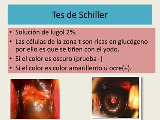 Tes de Schiller
• Solución de lugol 2%.
• Las células de la zona t son ricas en glucógeno
por ello es que se tiñen con el yodo.
• Si el color es oscuro (prueba -)
• Si el color es color amarillento u ocre(+).
 