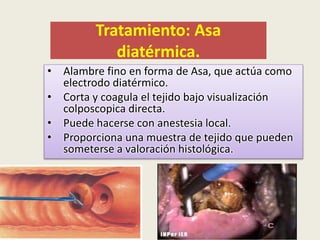 Tratamiento: Asa
diatérmica.
• Alambre fino en forma de Asa, que actúa como
electrodo diatérmico.
• Corta y coagula el tejido bajo visualización
colposcopica directa.
• Puede hacerse con anestesia local.
• Proporciona una muestra de tejido que pueden
someterse a valoración histológica.
 
