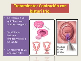 Tratamiento: Conización con
bisturí frio.
• Se realiza en un
quirófano, con
anestesia regional.
• Se utiliza en
lesiones
endocervicales, o
Ca In Situ.
• En mayores de 35
años con NIC 3.
 