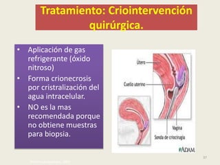 Tratamiento: Criointervención
quirúrgica.
• Aplicación de gas
refrigerante (óxido
nitroso)
• Forma crionecrosis
por cristralización del
agua intracelular.
• NO es la mas
recomendada porque
no obtiene muestras
para biopsia.
37
Williams ginegología, 2009.
 