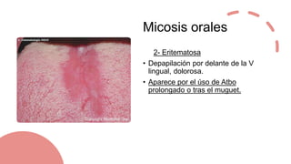 Micosis orales
• Hiperplásica crónica
• Las hifas pueden llegar a
invadir el epitlelio.
• Puede haber displasias
intraepit...