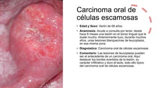 Carcinoma oral
células escamosas
• Edad y Sexo: Mujer de 77 años.
• Anamnesis: Acude a consulta por tener, desde
hace diez...