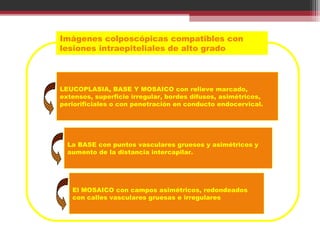 Imágenes colposcópicas compatibles con
lesiones intraepiteliales de alto grado
LEUCOPLASIA, BASE Y MOSAICO con relieve marcado,
extensos, superficie irregular, bordes difusos, asimétricos,
periorificiales o con penetración en conducto endocervical.
La BASE con puntos vasculares gruesos y asimétricos y
aumento de la distancia intercapilar.
El MOSAICO con campos asimétricos, redondeados
con calles vasculares gruesas e irregulares
 