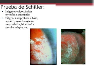 Prueba de Schiller:
• Imágenes colposcópicas
normales y anormales
• Imágenes sospechosas: base,
mosaico, mancha roja no
característica, hipertrofia
vascular adaptativa.
 
