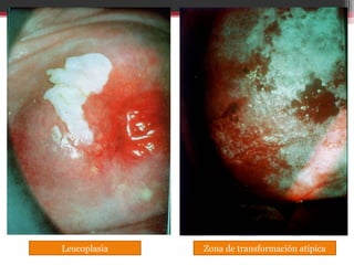 Leucoplasia Zona de transformación atípica
 
