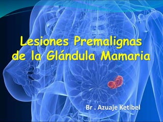 Lesiones Premalignas
de la Glándula Mamaria
Br . Azuaje Ketibel
 