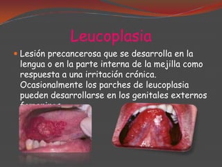 Leucoplasia
 Lesión precancerosa que se desarrolla en la
lengua o en la parte interna de la mejilla como
respuesta a una irritación crónica.
Ocasionalmente los parches de leucoplasia

pueden desarrollarse en los genitales externos
femeninos.

 