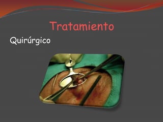 Tratamiento
Quirúrgico

 