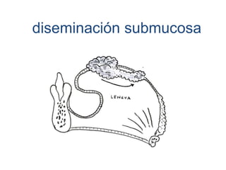 diseminación
musculoaponeurotica
 