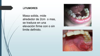 TUMORES
Masa solida, mide
alrededor de 2cm o mas,
se traduce en una
elevación firme con o sin
limite definido.
 