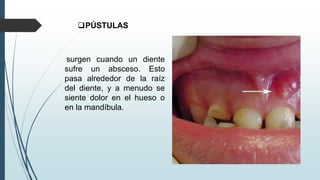 PÚSTULAS
surgen cuando un diente
sufre un absceso. Esto
pasa alrededor de la raíz
del diente, y a menudo se
siente dolor en el hueso o
en la mandíbula.
 