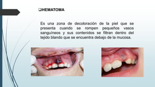HEMATOMA
Es una zona de decoloración de la piel que se
presenta cuando se rompen pequeños vasos
sanguíneos y sus contenidos se filtran dentro del
tejido blando que se encuentra debajo de la mucosa.
 