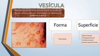 Pequeña elevación circunscrita de la piel, de contenido
líquido, seroso y claro por acumulación de plasma en la
epidermis o dermis
Forma
Redondeada
Superficie
Esférica (herpes)
Puntiaguda (eccema)
Umbilical (varicela)
Papulosa (papulovesícula)
 