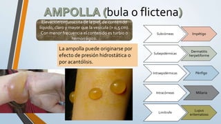 bula o flictena
La ampolla puede originarse por
efecto de presión hidrostática o
por acantólisis.
Elevación circunscrita de la piel, de contenido
líquido, claro y mayor que la vesícula (> 0,5 cm).
Con menor frecuencia el contenido es turbio o
hemorrágico.
Subcórneas Impétigo
Subepidérmicas
Dermatitis
herpetiforme
Intraepidérmicas
Intracórneas
Limítrofe
Lupus
eritematoso
Pénfigo
Miliaria
 